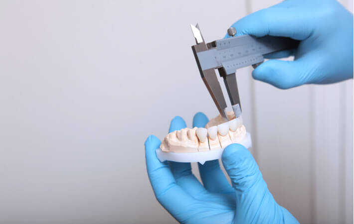 A dental technician measures veneers that have been attached to a dental cast.