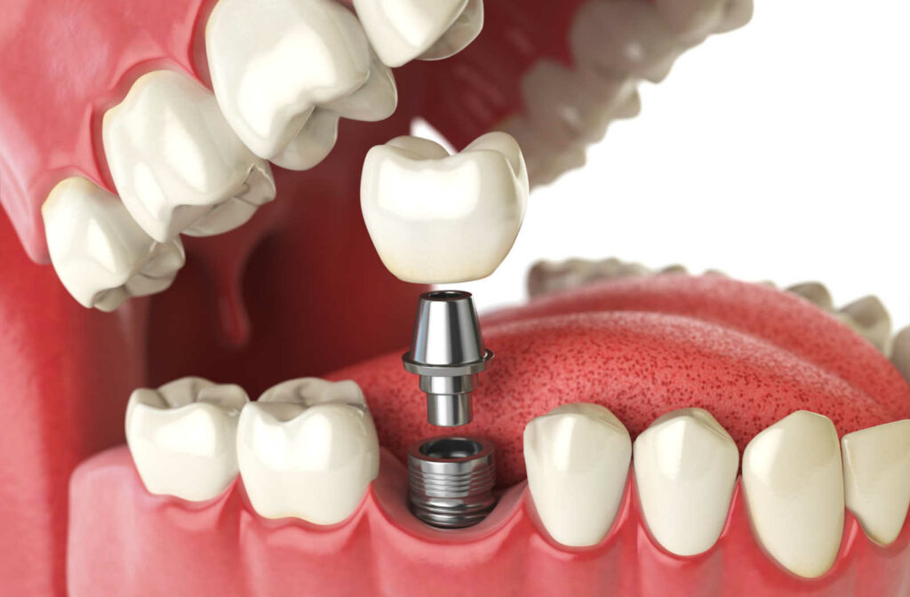 A 3d illustration of a dental implant and a crown to be attached together.