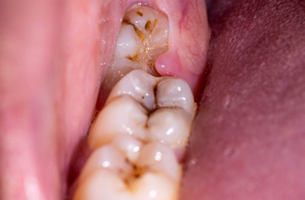 Can a Wisdom Tooth Cause an Abscess? Marks Dentistry
