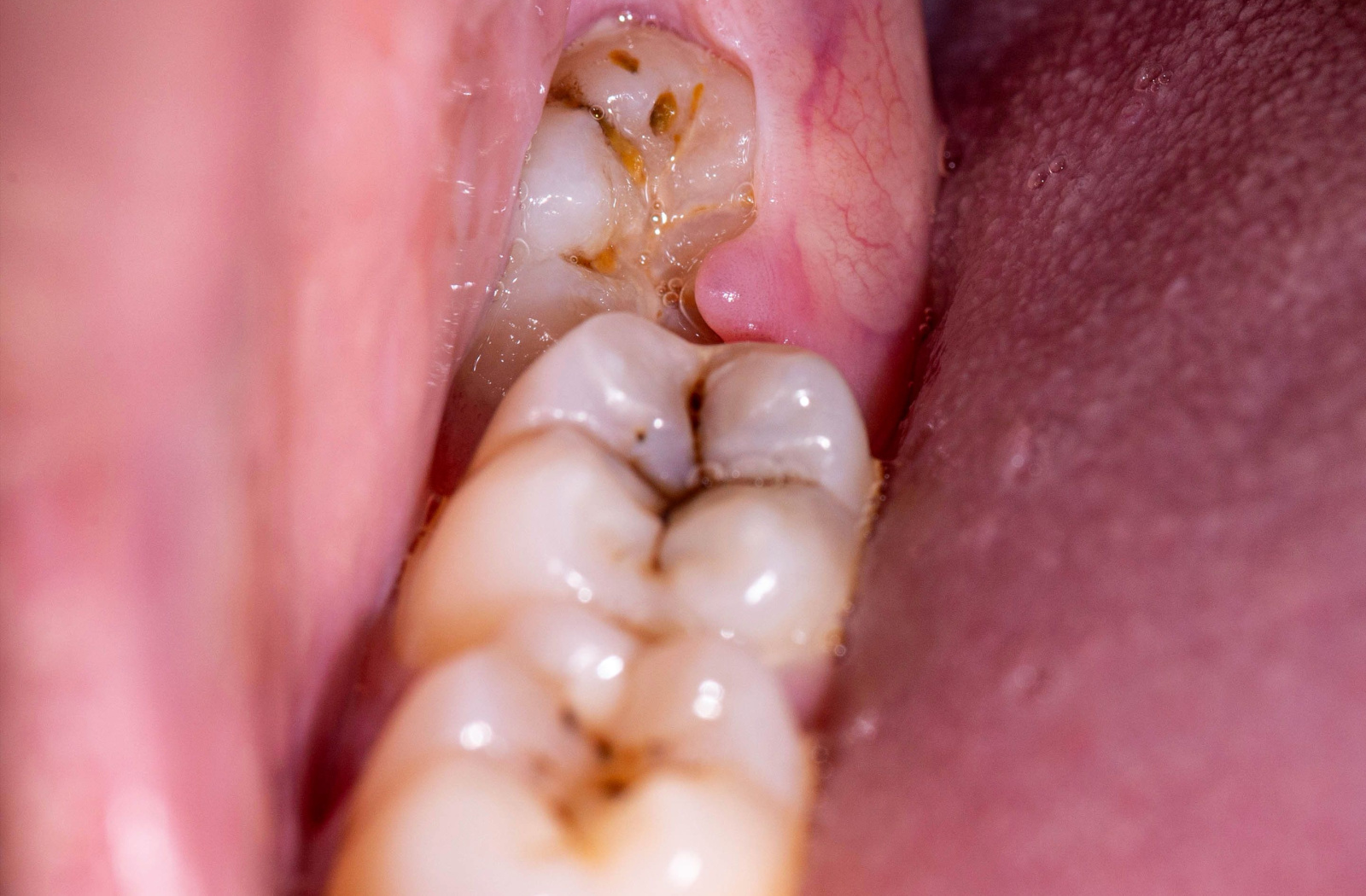 A close-up of an impacted wisdom tooth causing an abscess in the gums.
