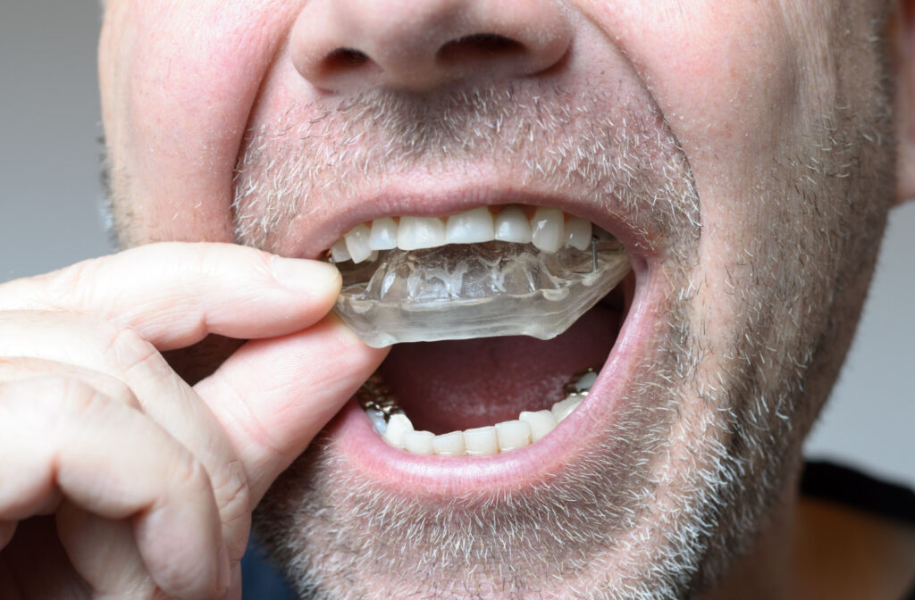 Close-up of a man's mouth placing a bite plate to protect his teeth.