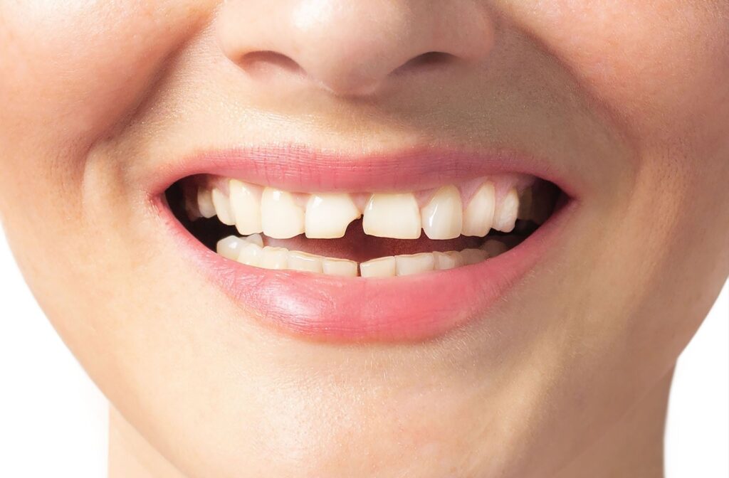 Woman smiling and showing chipped tooth.
