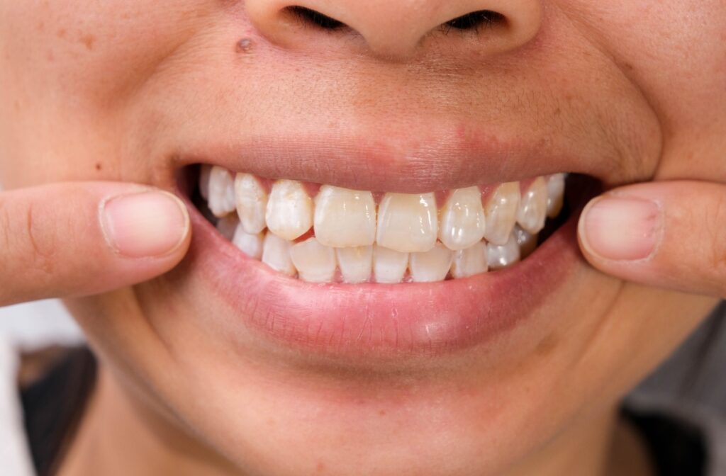 An intense close-up of a person's teeth with white stains.