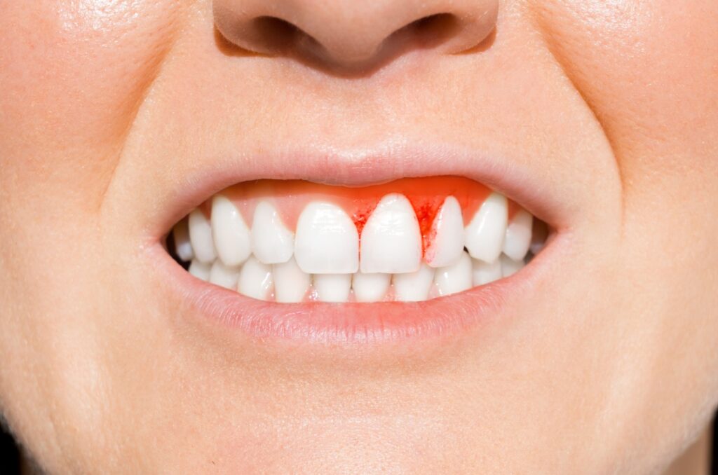 A close-up image of bleeding gums in gum disease.
