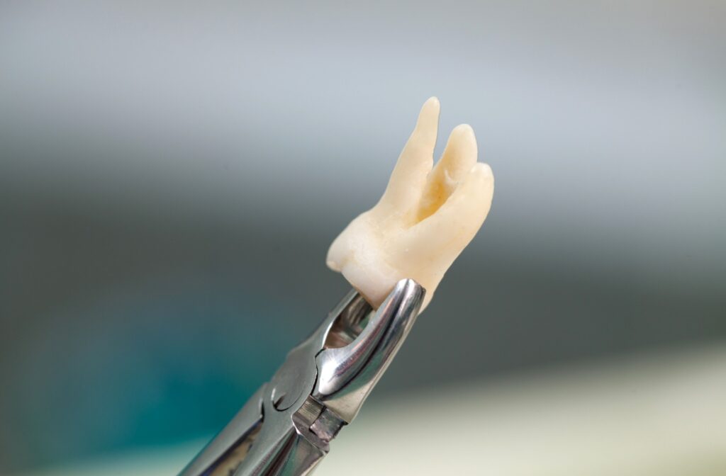 A wisdom tooth held by dental forceps during extraction.