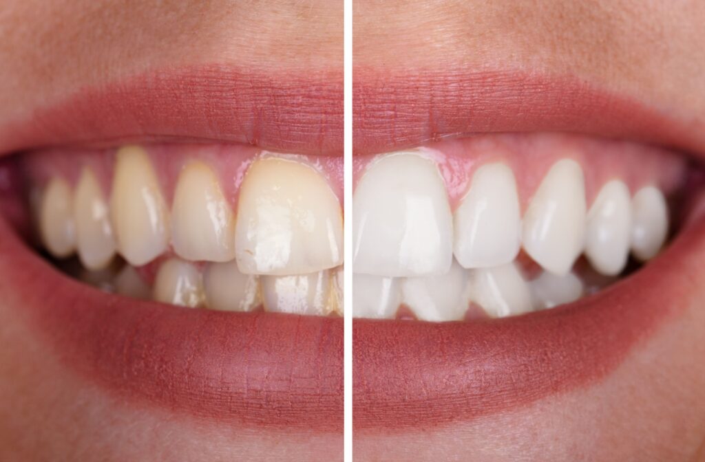 Close-up of a woman’s smile showing before and after results of professional teeth whitening.