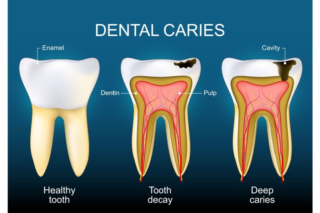 Medical diagram showing three stages of dental caries from healthy tooth to tooth decay to deep cavities with labeled tooth anatomy including enamel, dentin, and pulp.