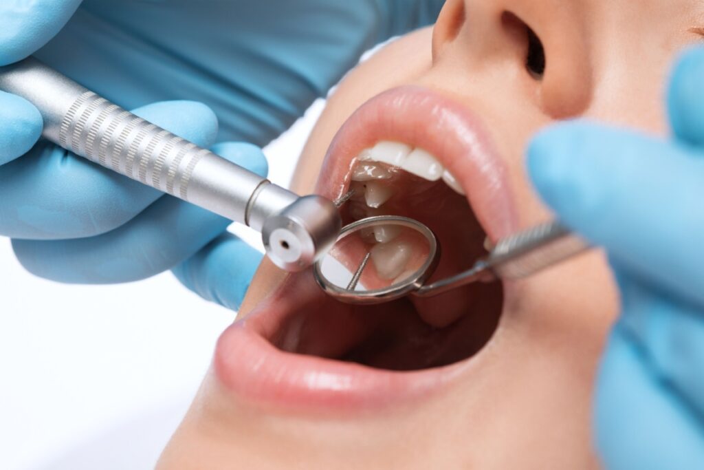 Patient receiving dental drilling treatment with high-speed handpiece and rubber dam isolation during cavity preparation procedure.