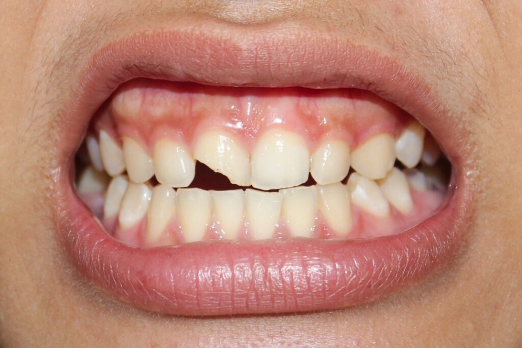 Up close image of a mouth with chipped front top right tooth.